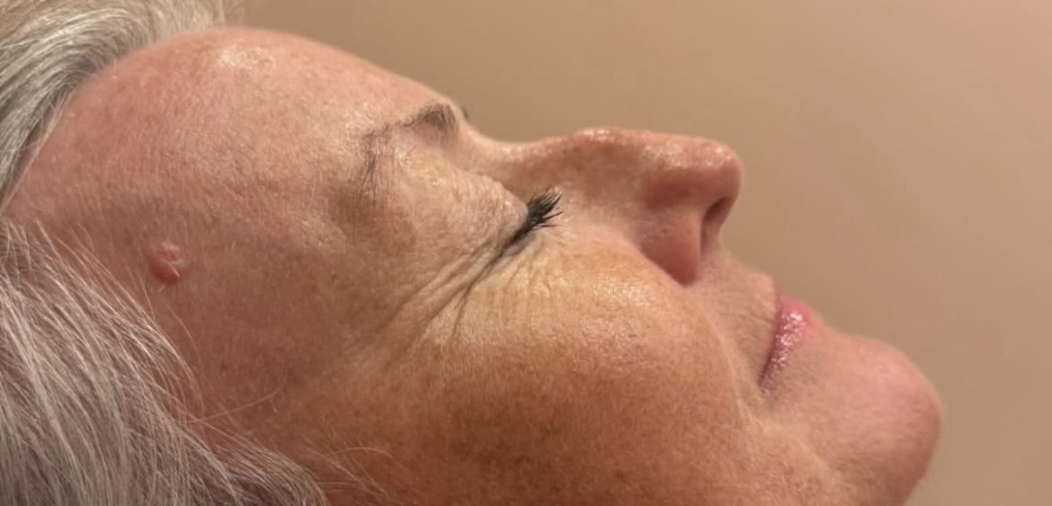 Rhinoplasty before treatment